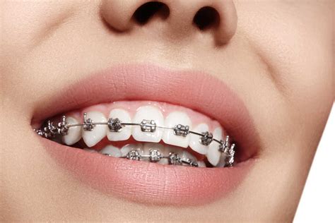 partes de los brackets metálicos|brackets de metal.